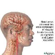 Migraine Treatment