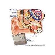 Cochlear Implants
